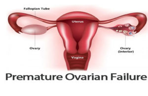 What is Premature Ovarian Failure