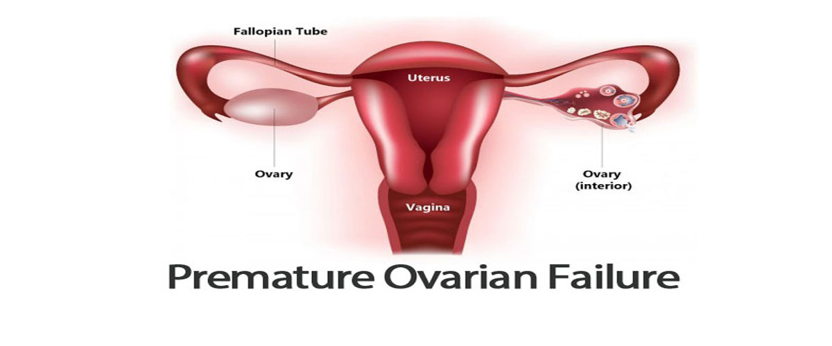 What is Premature Ovarian Failure