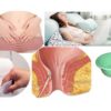 Rectovaginal Fistula: Causes, Symptoms, Treatment  and Home Remedies