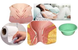 What is Rectovaginal Fistula
