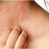 Easy Home Remedies To Get Rid Of Heat Rash In Summers