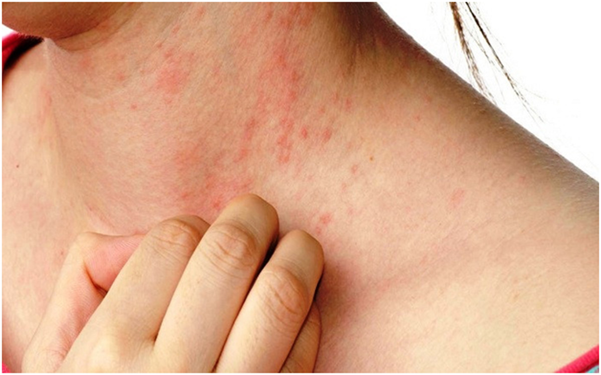 How To Get Rid Of Heat Rash In Summers