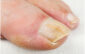 Will A Nail Salon Do Pedicure If you Have A Toe Nail Fungus?