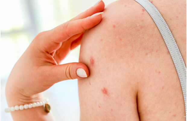 How To Get Rid OF Papules Naturally