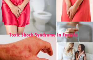 Toxic Shock Syndrome In Female: Causes And Prevention