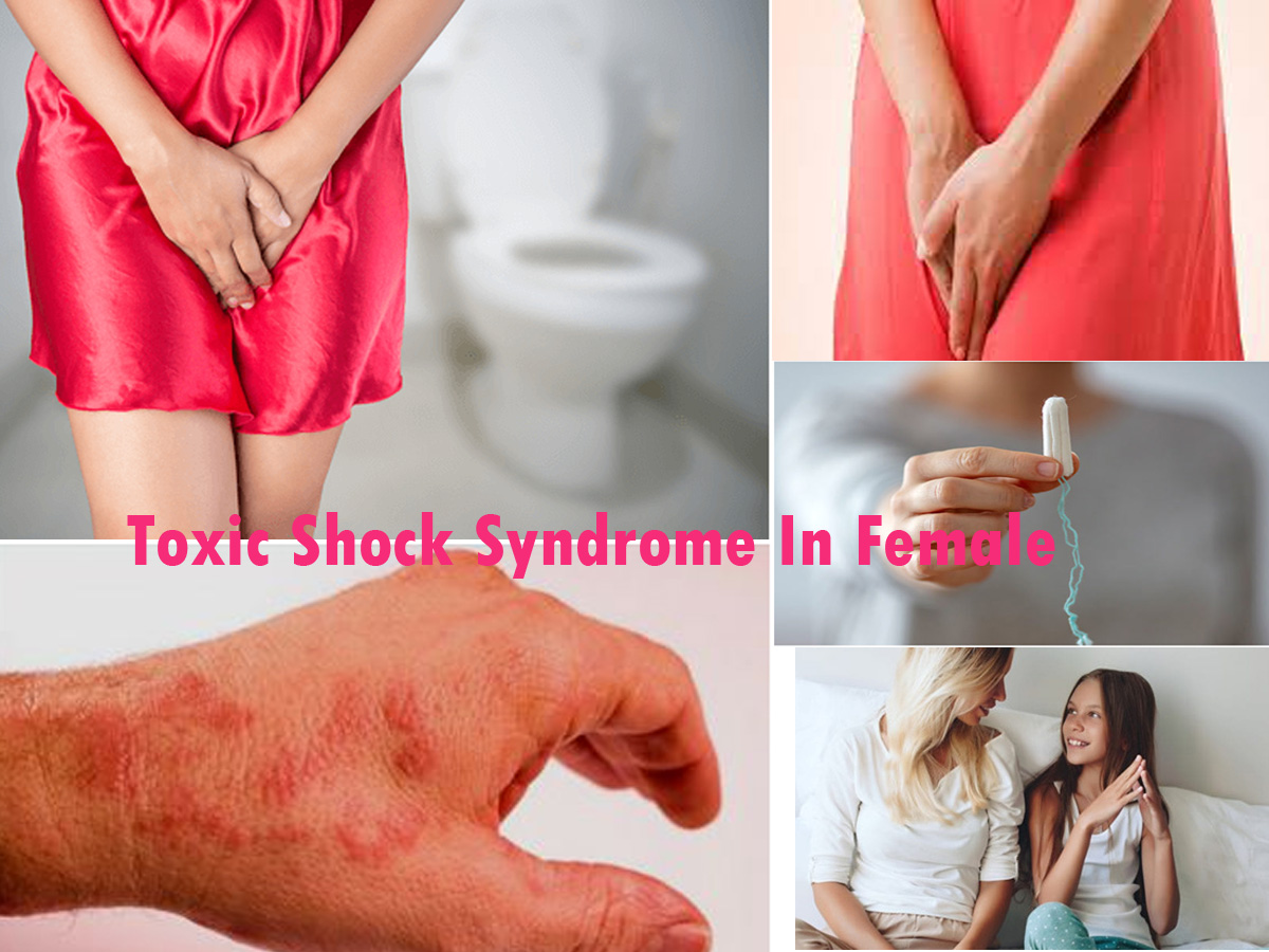 Toxic Shock Syndrome In Female: Causes And Prevention
