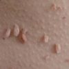 Vaginal Skin Tags: Causes and Treatment