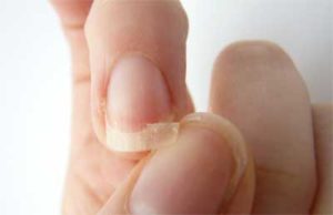 Brittle and Cracked Nails Indicate