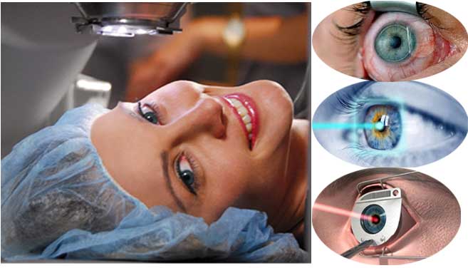 A Complete Guide to LASIK Eye Surgery