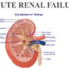 Acute Renal Failure: Definition, Incidence, Diagnosis, Management, Treatment