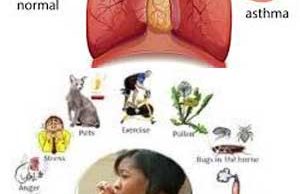 Asthma Disease