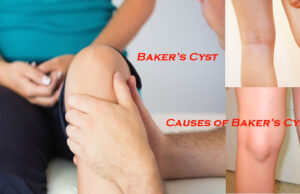 Baker’s Cyst: Causes, Symptoms, and Treatment