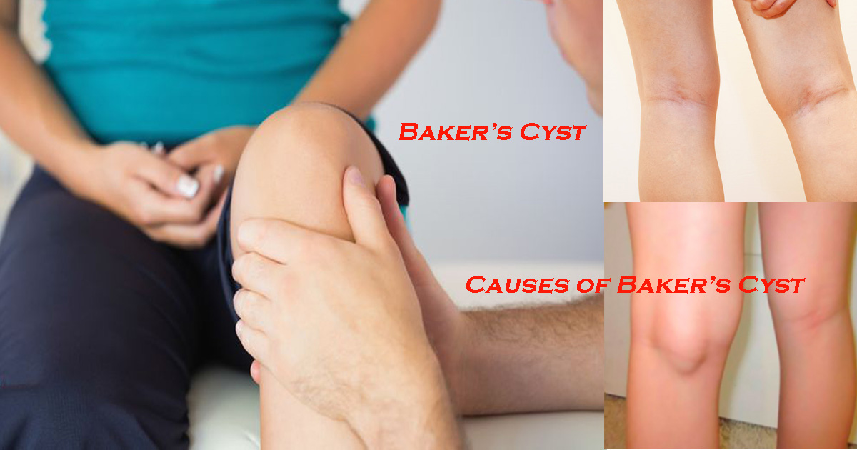Baker’s Cyst: Causes, Symptoms, and Treatment