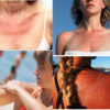 Best Home Remedies for Sun Poisoning