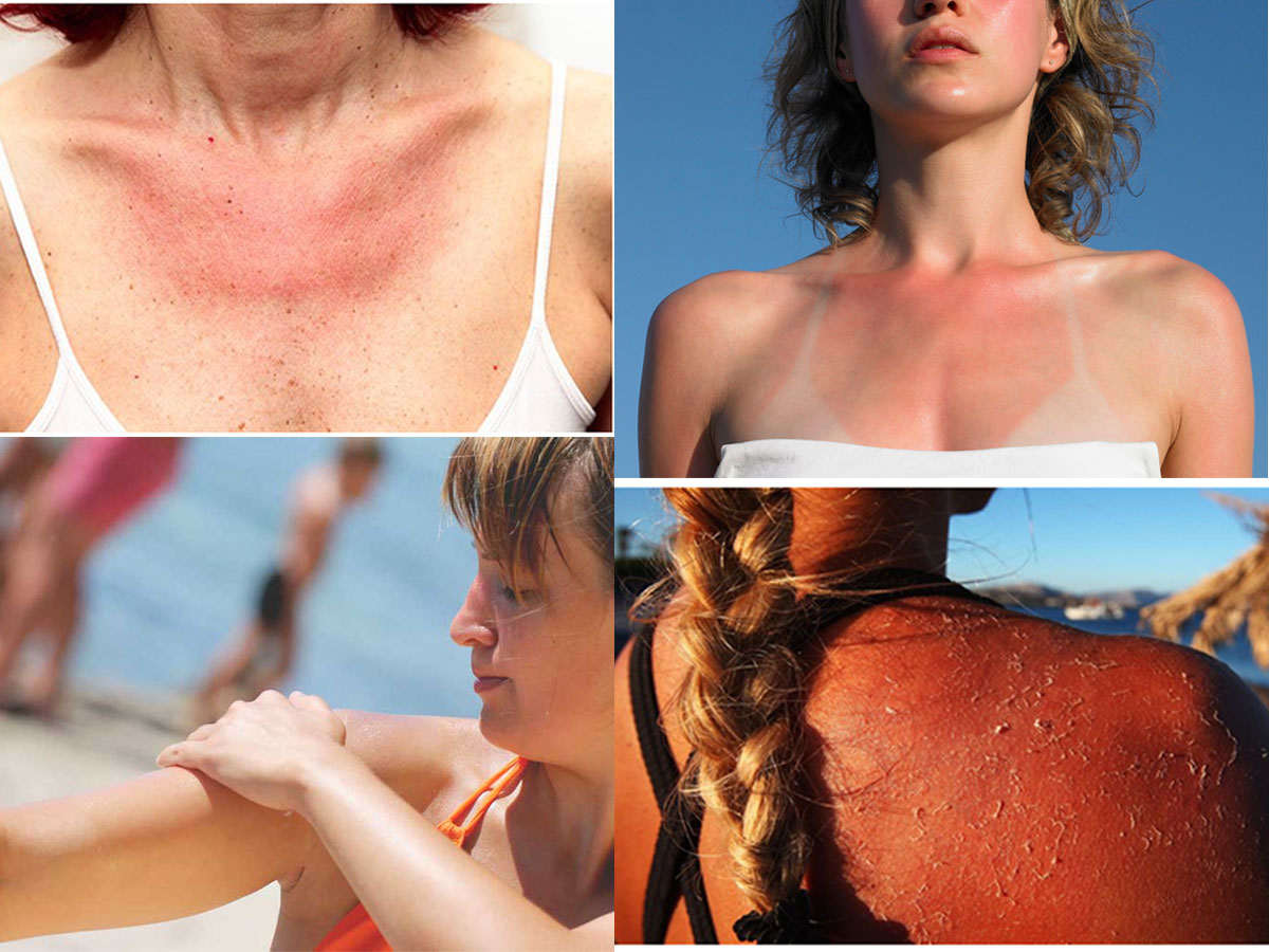 Best Home Remedies for Sun Poisoning