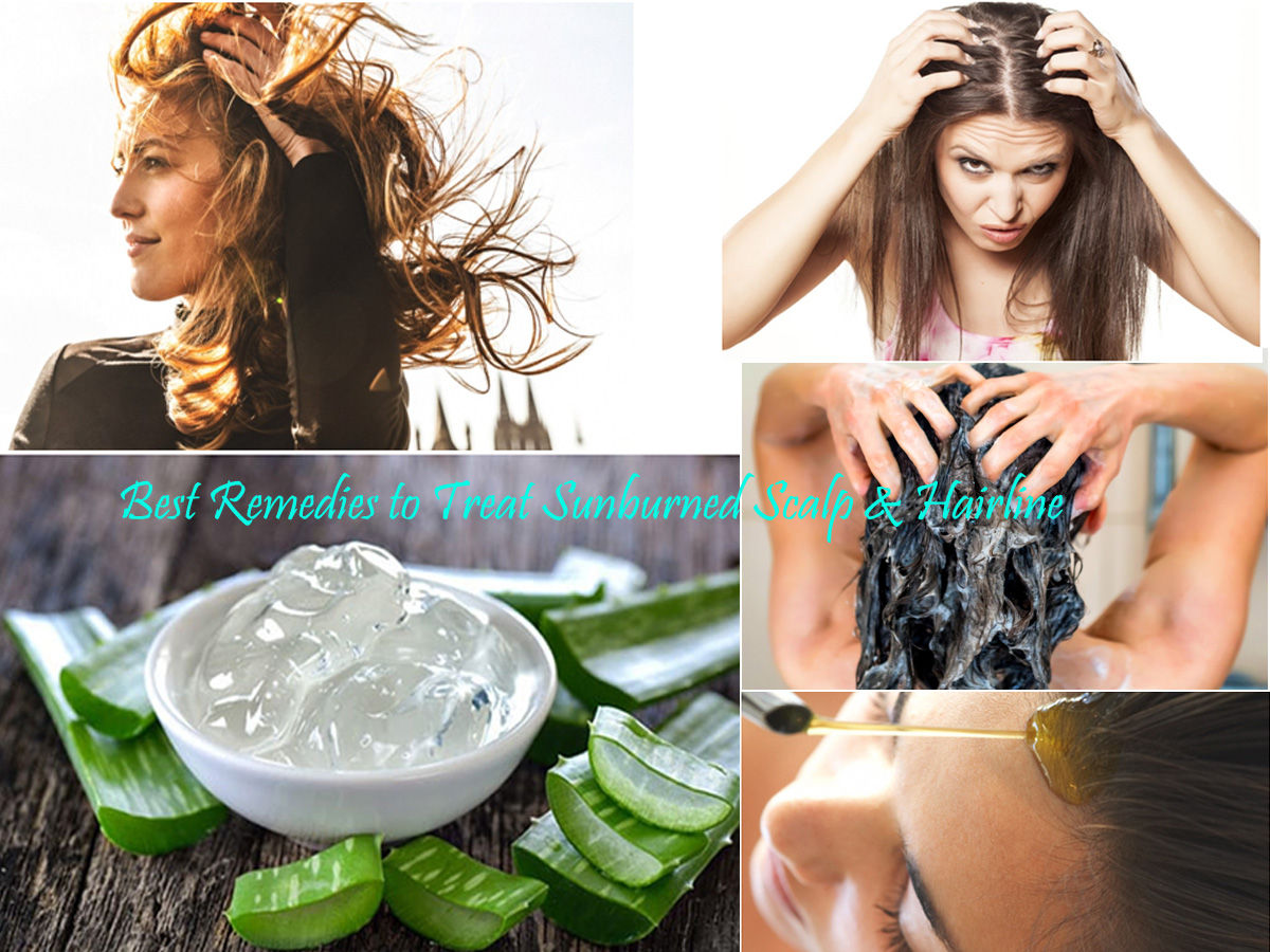 Best Remedies to Treat Sunburned Scalp & Hairline