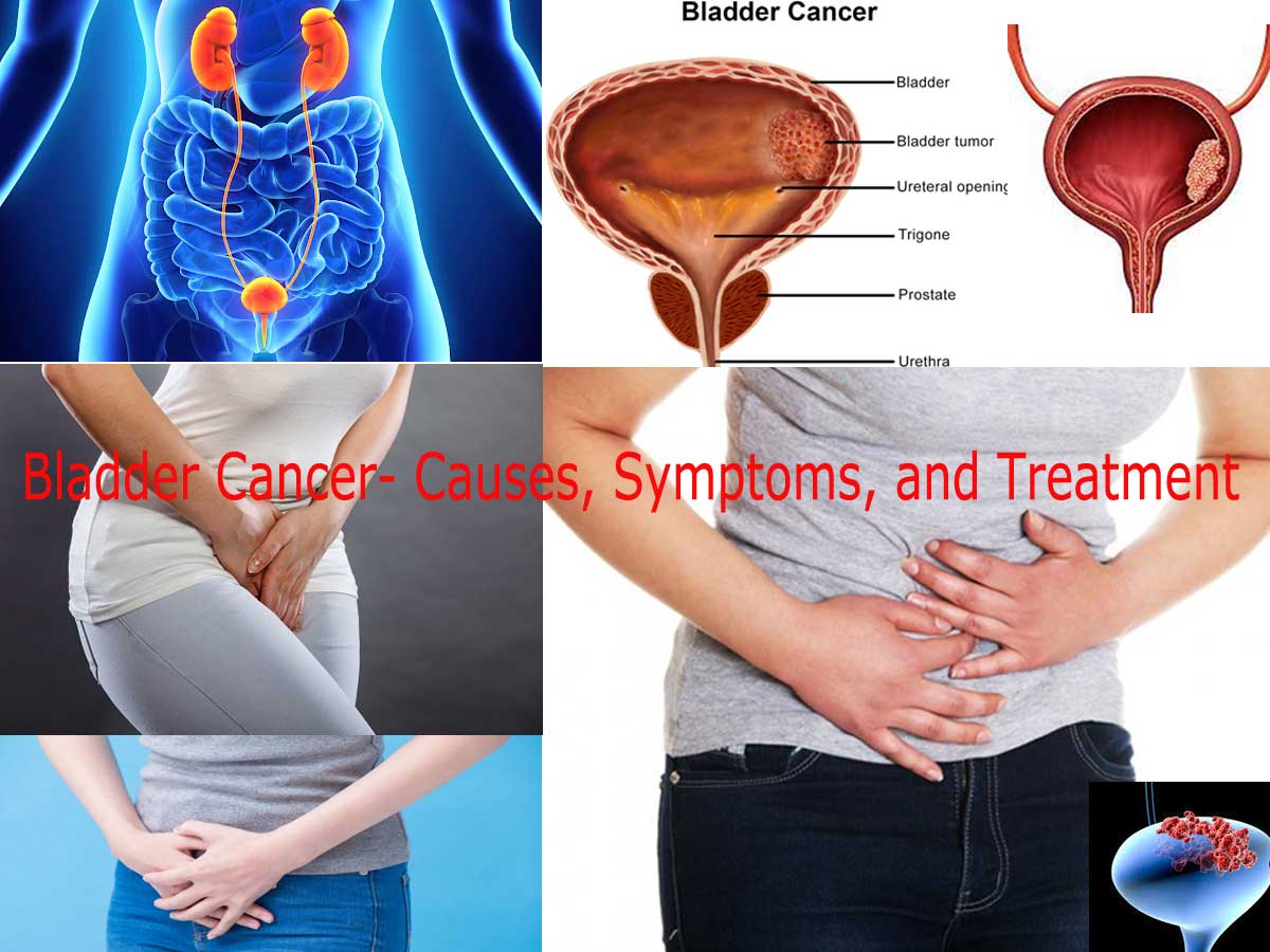 Bladder Cancer- Causes, Symptoms, and Treatment