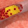 Atherosclerosis : Causes, Symptoms, Prevention and Treatment