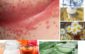 How to Get Rid of Sweat Rash Under Breast