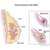 Breast Cancer: Types, Incidence, Causes, Risk Factors, Treatment