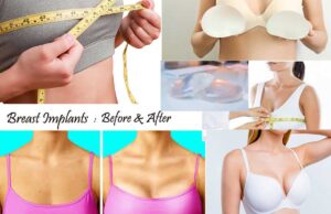 Breast Implants- All You Need to Know