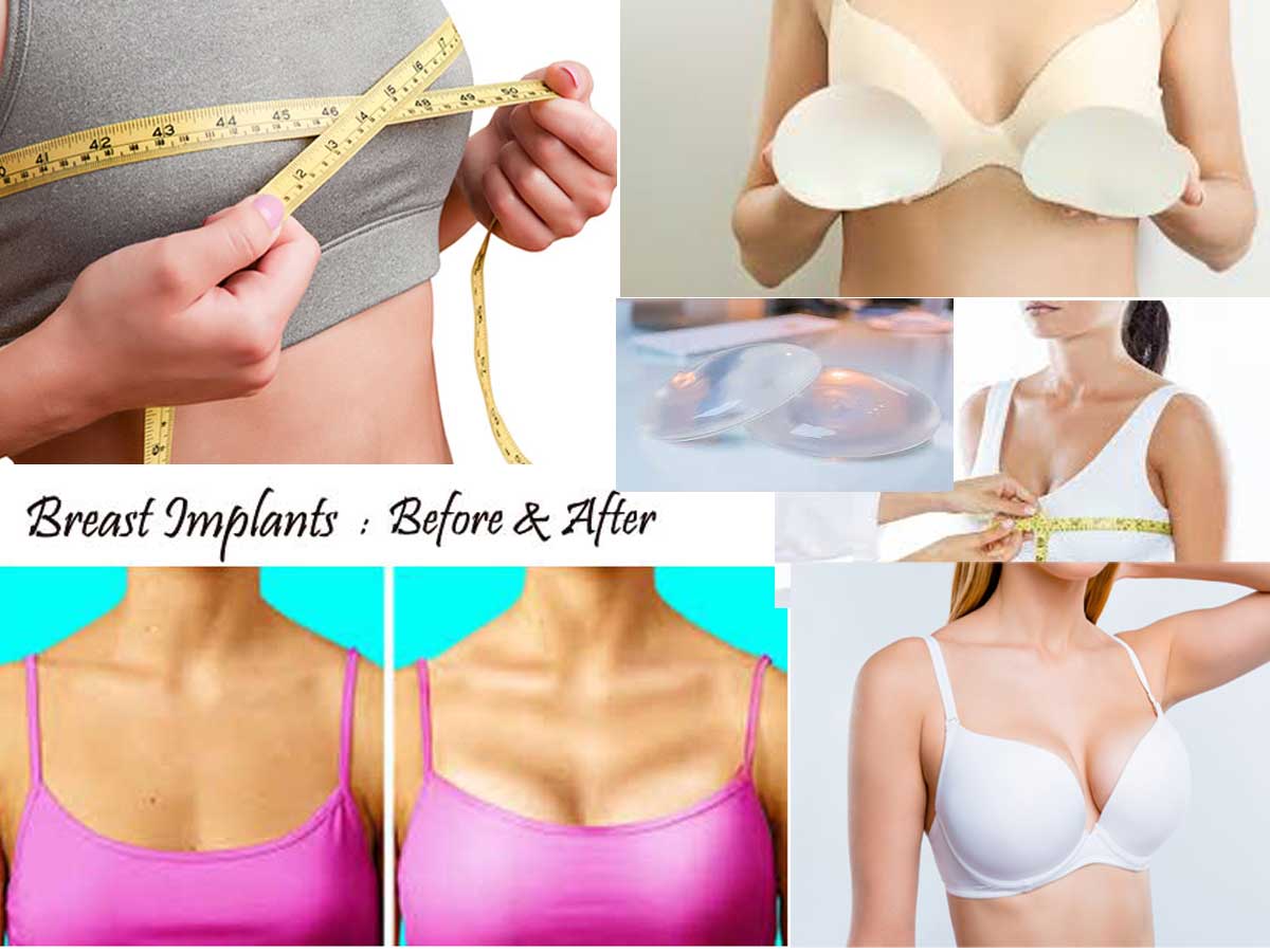 Breast Implants- All You Need to Know