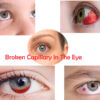 Broken Capillary In The Eye: Causes And Remedies