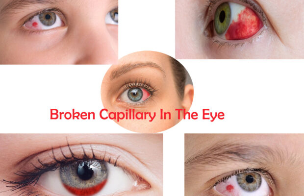 Broken Capillary In The Eye - Causes And Remedies