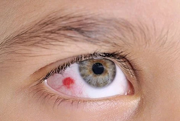 Broken Capillary In The Eye