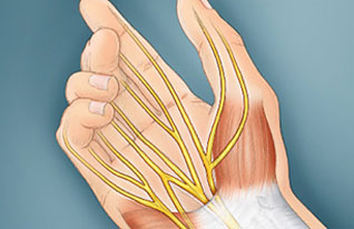 What is Carpal Tunnel Syndrome