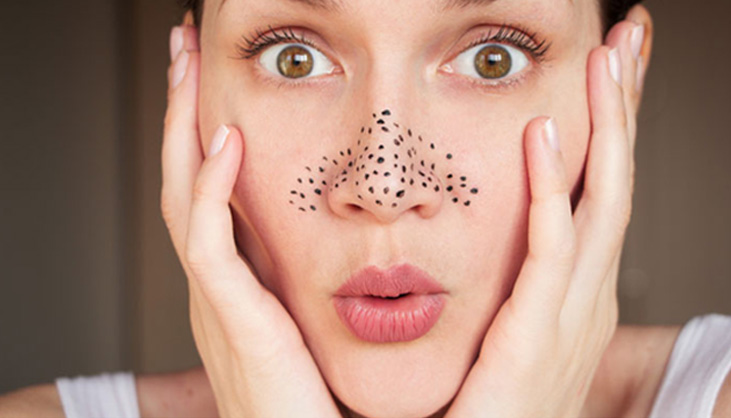 The Causes Of Blackheads Formed On Your Face And Nose