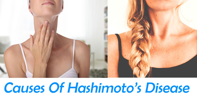 Common Causes Of Hashimoto’s Disease