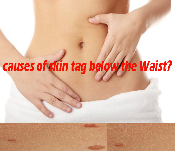 Causes of Skin Tags Below Your Waist