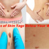 Causes of Skin Tags Below Your Waist: Natural Remedies And Prevention