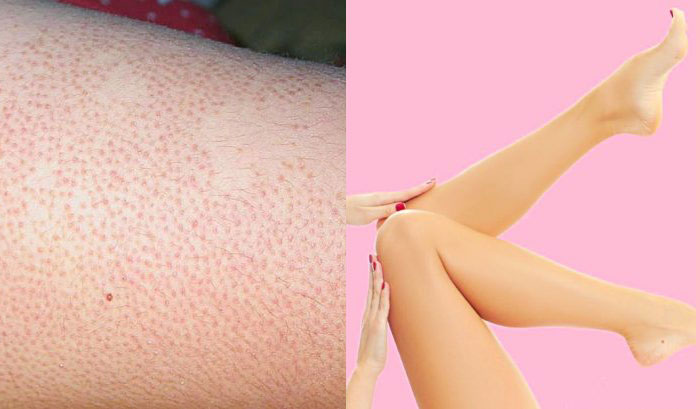 Causes of Strawberry Legs