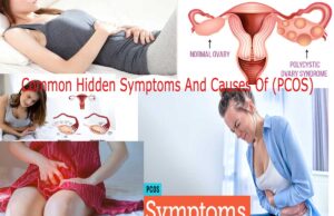 Common Hidden Symptoms And Causes Of (PCOS) Polycystic Ovary Syndrome