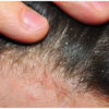 Are you Ignoring your Scalp Psoriasis for Simple Dandruff