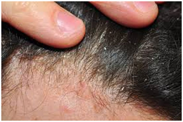 Ignoring your Scalp Psoriasis for Simple Dandruff
