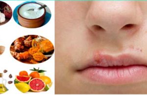 Effective Home Remedies for Lip Infections