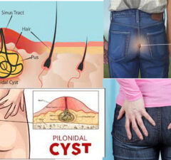 Effective Home Remedies for Pilonidal Cyst