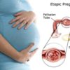 Ectopic Pregnancy: Symptoms Diagnosis and Treatment