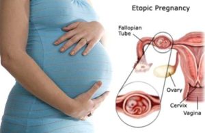 What is an Ectopic Pregnancy
