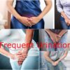 Frequent Urination- Causes,Symptoms,Diagnosis,Treatment,Prevention