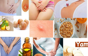 Get over from Private Part Boils with Home Remedies