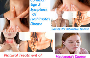 Hashimoto’s Disease: Causes, Symptoms And Natural Treatment