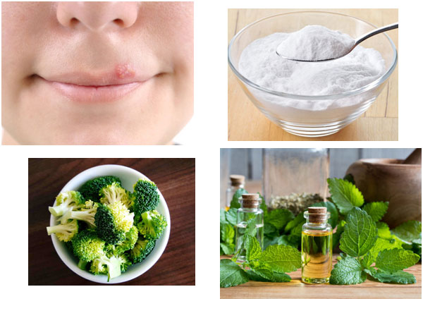 Home Remedies For Treating Herpes
