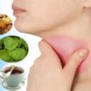 What is Sore Throat:Causes, Symptoms, Risk Factors, Treatments, Home Remedies