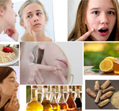 Home Remedies for Acne in Children