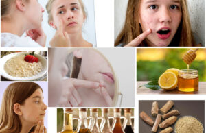 Home Remedies for Acne in Children