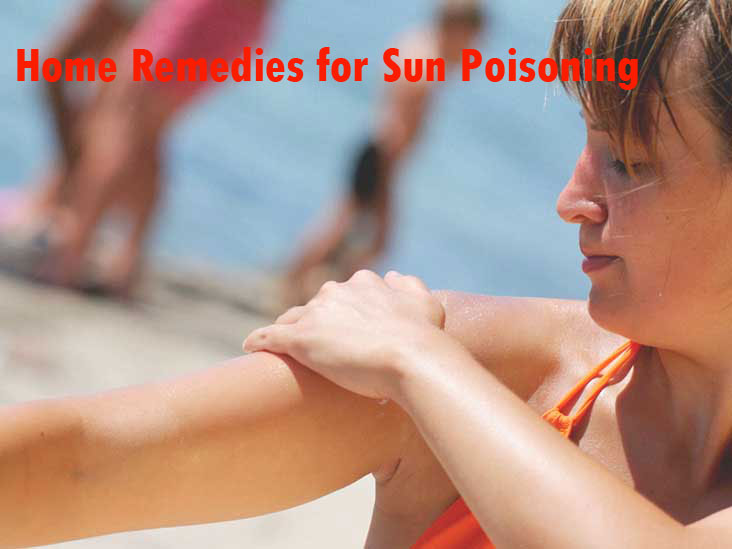 Home Remedies for Sun Poisoning